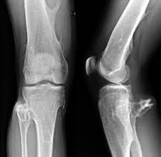 This is an image of someones leg with osteochondromas. 